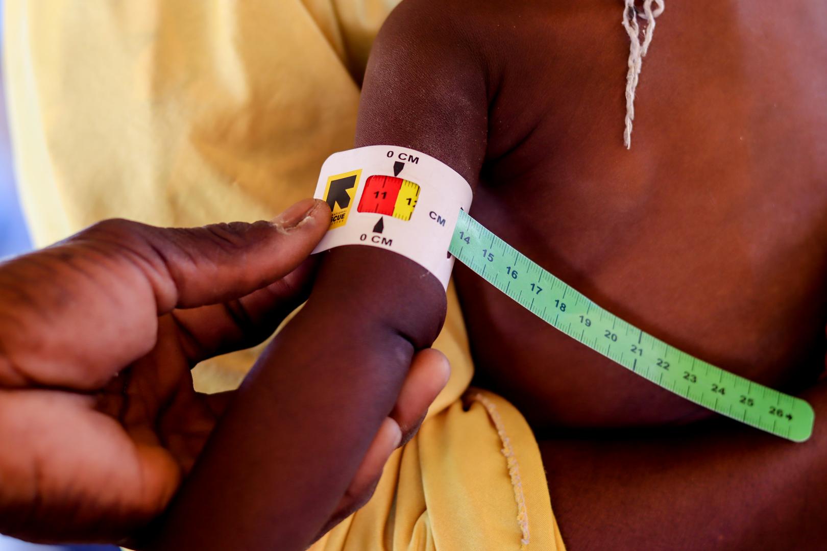 Centrafrique : Médecin Sans Frontières alerte sur la montée de la malnutrition à Bossangoa