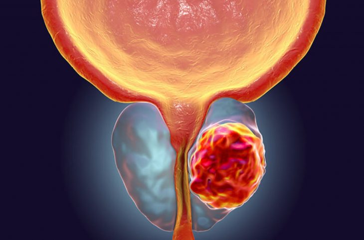 Cancer de la prostate : quelles précautions prendre pour l’éviter ?