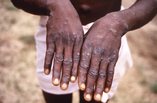 Santé : l’épidémie de la variole du singe en phase d’être maitrisée à Bangui