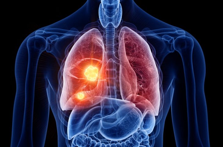 Pneumonie : comment l’éviter et quels sont traitements indispensables ?